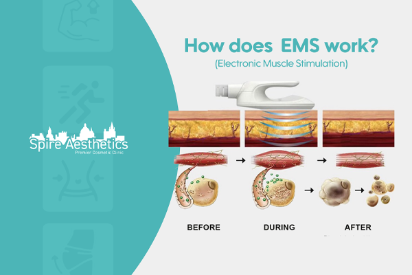 EMS treatment for post pregnancy weight loss treatment Esher