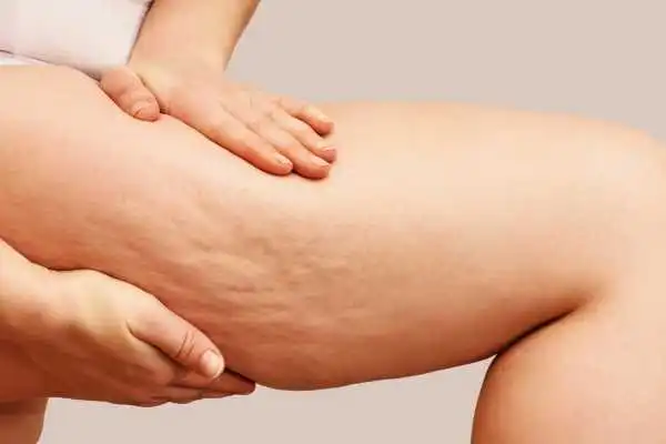 Image of woman showing leg with cellulite Esher