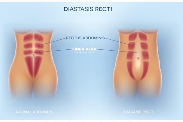 What Non-Surgical Options Are Available for Diastasis Recti Esher?