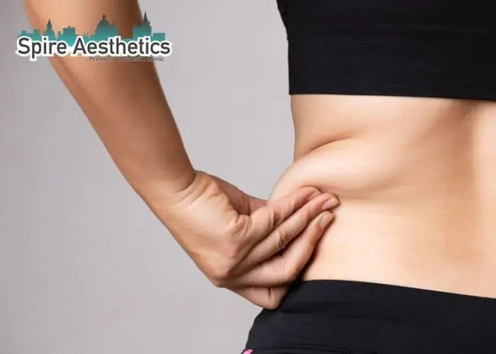 Image of woman pinching fat on their hips Esher. Fat Freezing treatment
