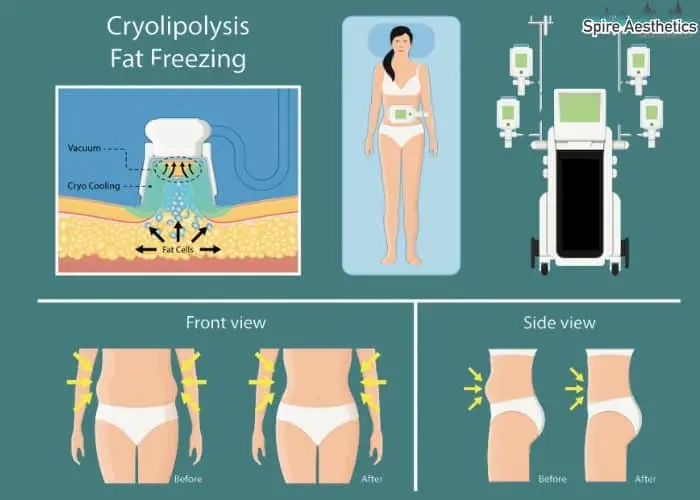 Fat freezing treatment Esher benefits for competitions to remove stubborn fat deposits.