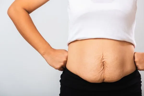 Image of a woman's stomach after weight loss with sagging skin following a gastric band Esher