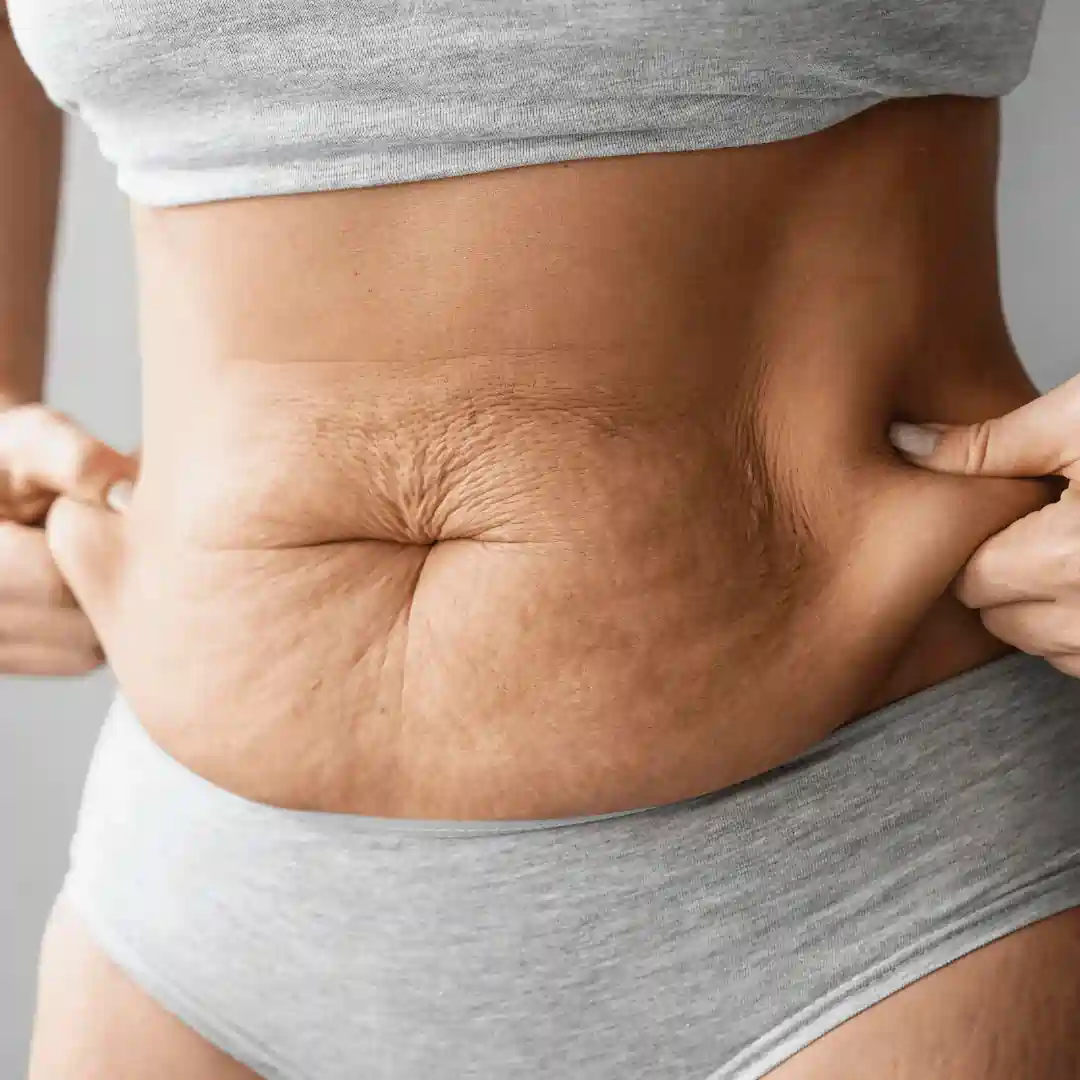Is It Normal to Have Loose Skin After Pregnancy Esher?
